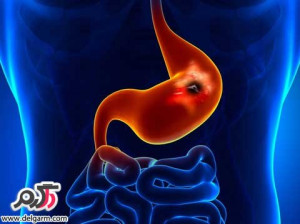 زخم معده /علائم زخم معده / درمان زخم معده