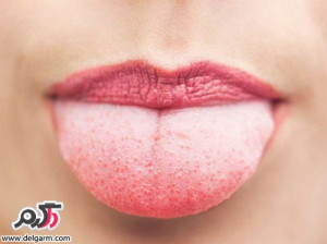 بهترین راه کارهای درمان سوختگی دهان و تاثیر باور نکردنی تخم مرغ برای سوختگی