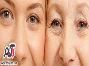 بهترین درمان ها برای چین و چروک اطراف چشم کاملترین مقاله