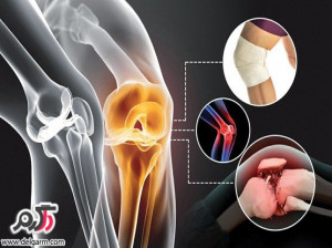 درمان درد آرتروز زانو و زانو درد کاملترین مقاله +فیلم