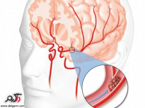 آنچه که باید درباره ی سکته ی مغزی بدانید! انواع سکته ی مغزی