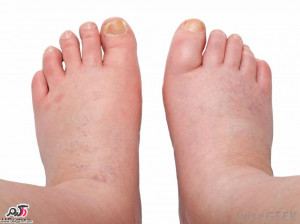 دلایل ورم و تورم پا چیست؟