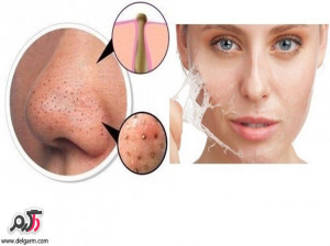 چگونه جوش های سر سیاه (کومودون ) را از بین ببریم؟