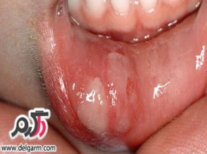 درمان آفت دهان به روش طب سنتی