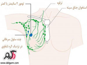 علت زدن توده ی زیر بغل چیست؟