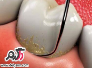 چگونه جرم های دندان را به آسانی از بین ببریم؟