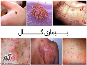 درمورد بیماری گال چه میدانید؟