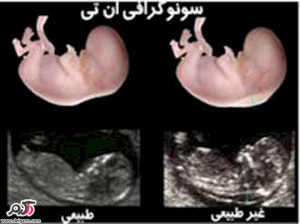 غربالگری و سلامت جنین در چه ماهی انجام می شود؟