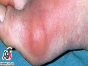 عوارض خطرناک بیماری نقرس