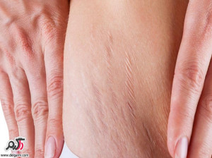 علل ایجاد خطوط و ترک روی پوست شکم و پهلو