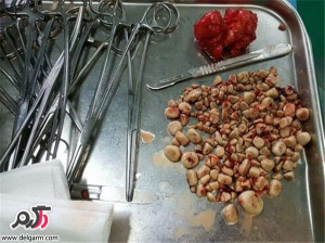 راه های مناسب برای دفع سنگ مثانه