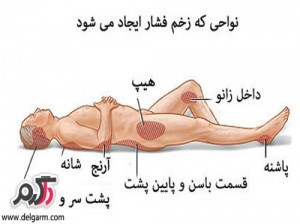 پیشگیری و درمان زخم بستر