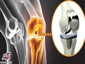 راه های مناسب برای پیشگیری از عفونت مفاصل
