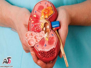 دفع سنگ کلیه در طب سنتی