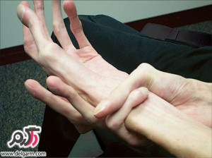 علائم؛دلایل و درمان سندروم مارفان