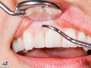 علت ایجاد و درمان کیست های فکی