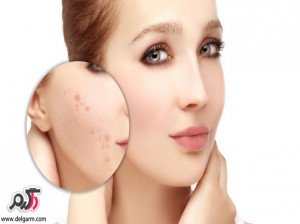 درمان خال های پوستی به روش طب سنتی