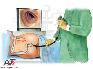 کولونوسکوپی چیست؟چگونه انجام میشود؟(همه چیز راجع به کولونوسکوپی)