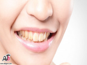 علت ایجاد لکه قهوه ای و زرد روی دندانها چیست؟