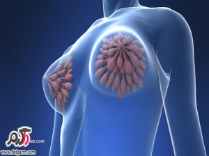 علت سرطان سینه و درمان سرطان پستان(Breast Cancer)