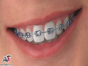 علت پوسیدگی دندان‌ها در زمان ارتودنسی + درمان