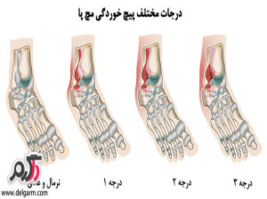 درمان پیچ خوردگی( کشیده شدن رباط) مچ پا