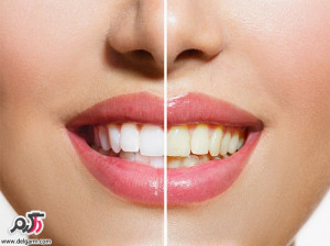 زرد بودن رنگ دندان ها نشانه چیست؟