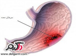 تشخیص سرطان روده با تست مدفوع M2-PK