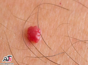 خطرات آنژیوم(خال های قرمز)روی بدن چیست؟