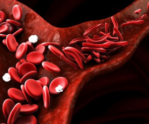 علائم کم خونی داسی شکل چیست و چگونه درمان میشود ؟