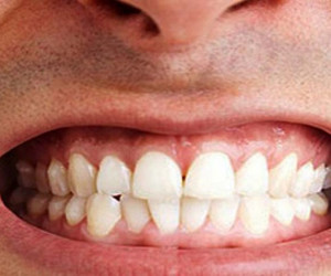 علائم و راههای درمان دندان قروچه در خواب چیست ؟
