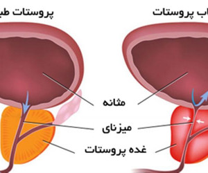 التهاب پروستات چیست ؟ آیا التهاب پروستات درمان میشود ؟