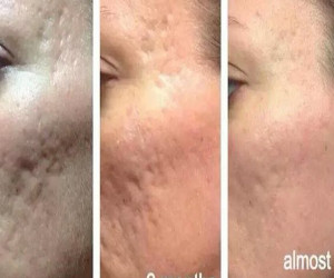 همه چیز درباره سابسیژن و سابسیژکتور