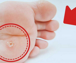 زگیل کف پا چیست و چه علائمی دارد ؟