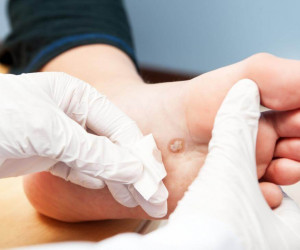 بررسی تشخیص و علل ایجاد زگیل کف پا