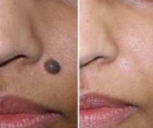 بروز خال در سن 30 سالگی را جدی بگیرید