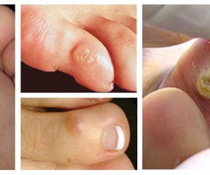 علت ایجاد میخچه در پا بانوان
