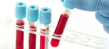 WBC نرمال در آزمایش خون چند است ؟