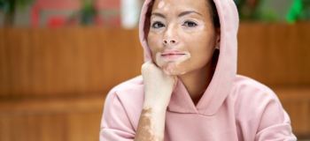حکم ازدواج در صورت مخفی کردن بیماری پیسی زن یا مرد چیست؟