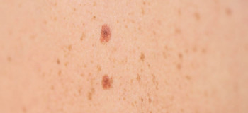 درمان، رفع و از بین بردن لکه‌های تیره روی پوست سینه
