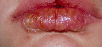 نشانه و علت عفونت لب بعد از تزریق ژل