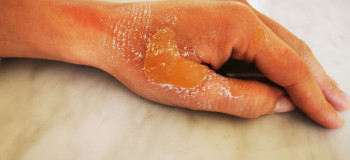 درمان و بهبود سریع سوختگی پوست در اثر روغن داغ