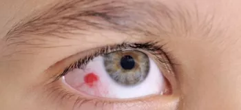 بهترین راه درمان لکه قرمز (لکه خونی) در چشم