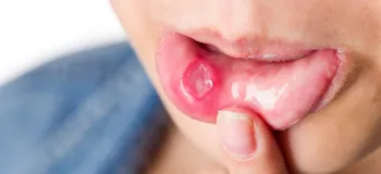 روش درمان موکوسل دهان چیست ؟
