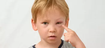 دلایلی که باعث ایجاد ورم پلک چشم در کودکان می شود