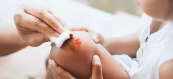 درمان اضطراری زخم و بریدگی عمیق روی پوست کودکان