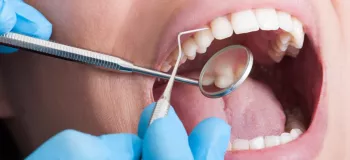 آیا کامپوزیت دندان سبب پوسیدگی زودهنگام دندان می شود ؟