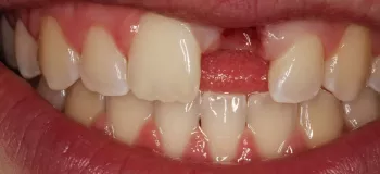 برای جای خالی دندان جلو بریج بهتر است یا ایمپلنت؟!