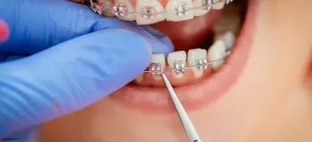 ارتودنسی یا سیم کشی دندان در چه سنی مناسب است؟