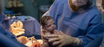 چهره جدید ایزابل روشا نوزاد بی اعصاب برزیلی پس از چند سال